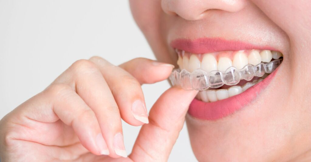 Braces in Kalyan