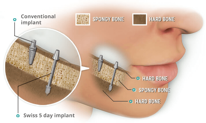 Situational Implantology in Kalyan