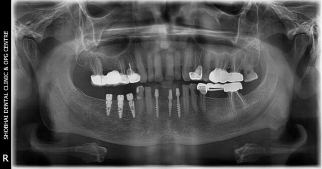 gorakh patil post op